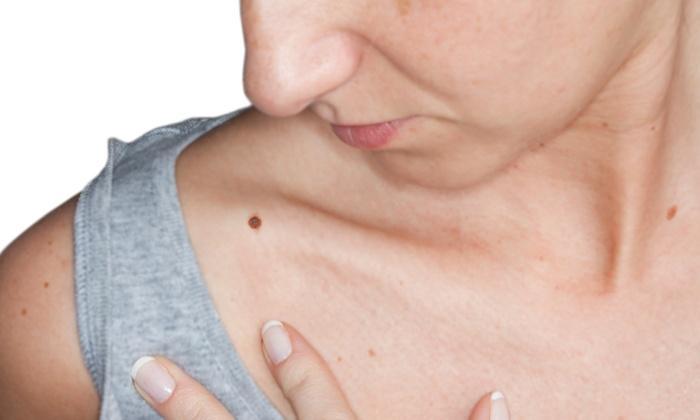 Papiloma – infekcinė odos liga